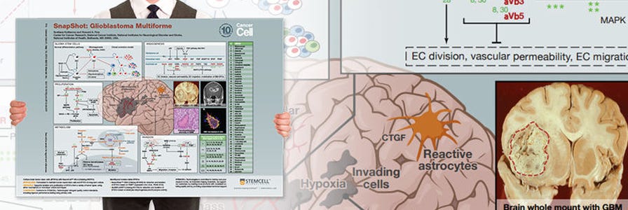 Image of a glioblastoma multiforme wallchart